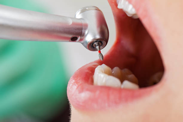 Best Emergency Dental Extractions in Trinity, NC